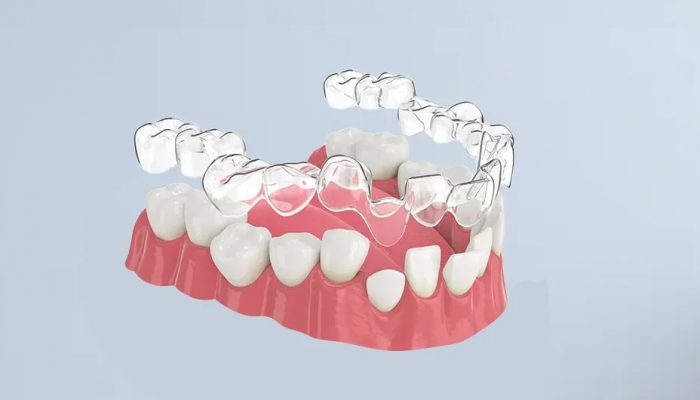 3D-printed-clear-aligners