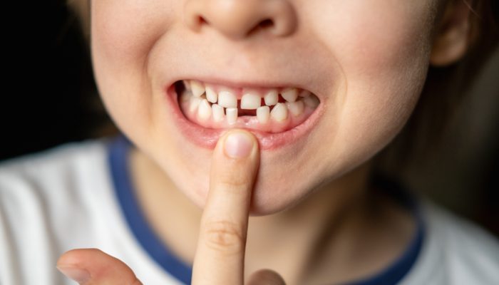 Portrait of little boy with open mouth without one front milk tooth. Loss of baby primary teeth. Waiting for growth of permanent molar tooth